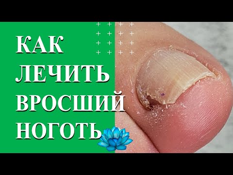 Видео: Вросший ноготь на ноге. Удаление вросшего ногтя.