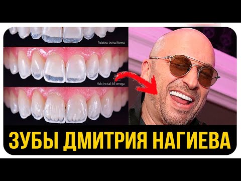 Видео: Дмитрий Нагиев. До и После. Кривые Зубы Знаменитостей. Сколько Стоят Элайнеры или Виниры?