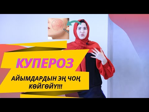 Видео: Купероз деген эмне?! | Айымдардын эң чоң кѳйгѳйү!!! | Айнура Сагынбаева