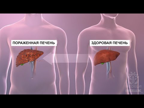 Видео: Трансплантация печени. Процесс пересадки печени