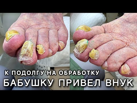 Видео: Бабушка 76 ПРИВЁЛ ВНУК. Не может подстричь ногти. Онихогрифоз