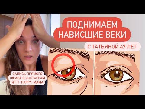 Видео: Нависшие верхние веки