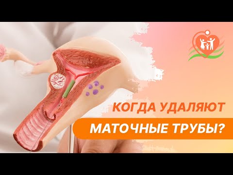 Видео: 👉 Когда удаляют маточные трубы?