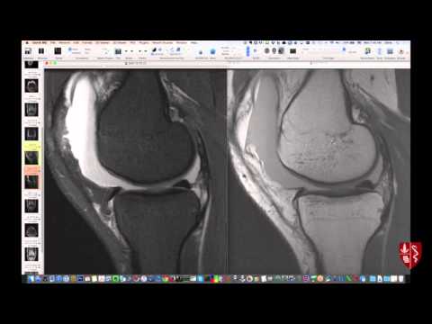 Видео: Дополнительные случаи МРТ коленного сустава, часть 2
