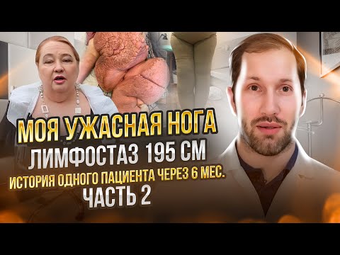 Видео: МОЯ УЖАСНАЯ НОГА: ЛИМФОСТАЗ 195 см - история одного пациента - часть 2 - отдаленные результаты