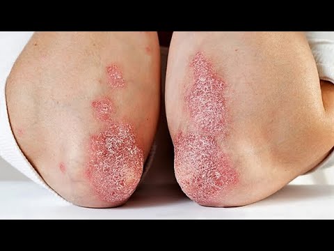 Видео: Комплексная терапия псориаза. КЛИНИЧЕСКИЕ РЕКОМЕНДАЦИИ. (проф. Силина Л.В.)