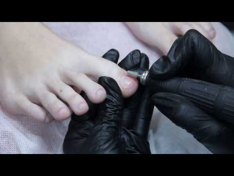 Видео: Постановка BS пластины/коррекция вросшего ногтя, тампонада/Bs brace application