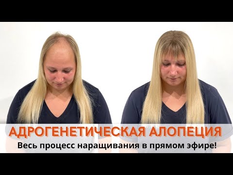 Видео: Решение проблемы при андрогенетической алопеции!