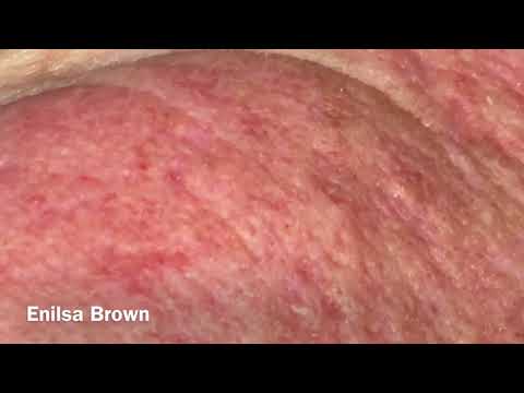 Видео: Удаление солнечных комедонов и куперозной кожи / Мотоциклист