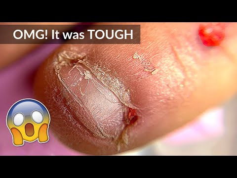 Видео: Очень длинные обгрызенные ногти — маникюр и наращивание. Преображение.