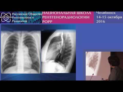 Видео: И.З. Коробкова - Легочная гипертензия