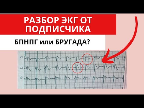 Видео: Разбор ЭКГ от подписчика. Паттерн Бругада.