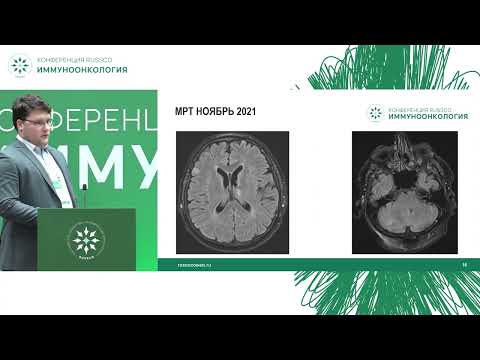 Видео: Иммуноонкология. Мелкоклеточный рак легкого. Клинический случай