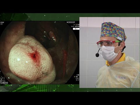 Видео: Завьялов Д.В. - удаление аденомы с дисплазией высокой степени с помощью эндоскопа Fijifilm-EG-760Z