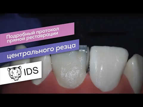 Видео: IDS | Подробный протокол прямой реставрации центрального резца
