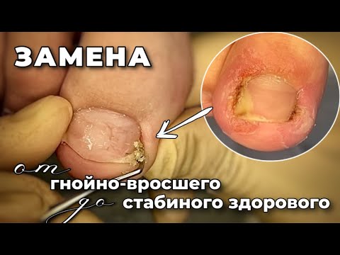 Видео: От горьких слез до улыбки. Сложный кейс Вросший ноготь 12 лет. 