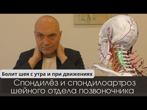 Видео: БОЛИТ ШЕЯ С УТРА И ПРИ ДВИЖЕНИЯХ: спондилёз и спондилоартроз шейного отдела позвоночника (Симптомы)