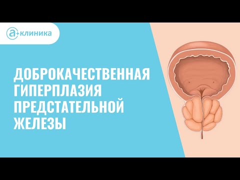 Видео: Доброкачественная гиперплазия предстательной железы