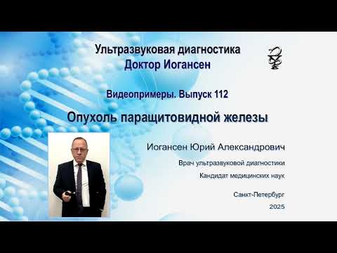 Видео: Ультразвуковая диагностика. Доктор Иогансен. Видеопримеры. Выпуск 112. Опухоли паращитовидных желез.