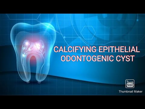 Видео: Кальцифицирующая эпителиальная одонтогенная киста (КЭК)