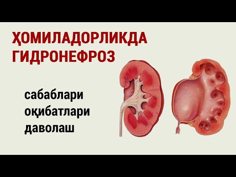 Видео: Ҳомиладорликда гидронефроз. Сабаблари, оқибатлари ва даволаш