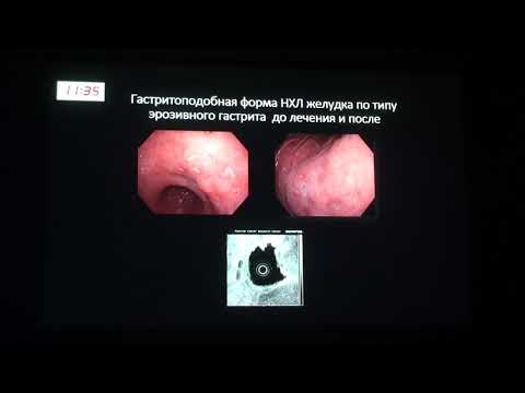 Видео: 1 Малихова О.А., Лозовая В.В., Эндоскопическая диффдиагностика неходжкинских лимфом желудка