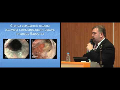 Видео: Комплексный лечебно-диагностический алгоритм у больных пищеводом Барретта