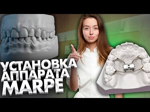 Видео: Установка ортодонтического аппарата для быстрого небного расширения MARPE. Клинический случай