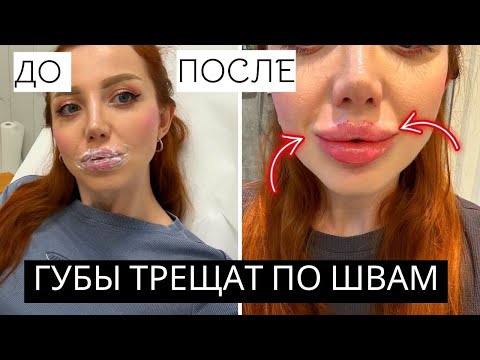 Видео: ДЕЛАЮ 4 МЛ ФИЛЛЕРА В ГУБЫ. ГУБЫ ТРЕЩАТ ПО ШВАМ! ЧТО СЛУЧИЛОСЬ С ГУБАМИ ПОСЛЕ