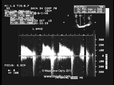Видео: Пацієнтка з важкою ревматичною мітрально-аортальною вадою серця