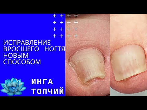 Видео: Вросший ноготь. Лечение вросшего ногтя новый способ.