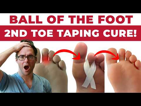 Видео: Боль во 2-м пальце ноги, капсулит и тейпирование подушечек стопы [домашнее лечение, 2022 г.]