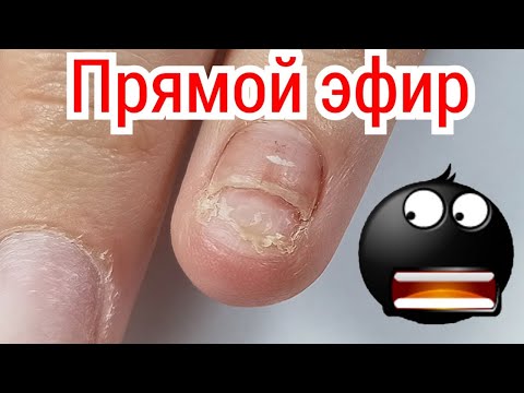 Видео: ТРЕШ! Ремонт Сорванного Ногтя. Комби Маникюр.  Прямой Эфир Виктория Авдеева