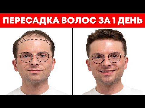 Видео: Как проходит пересадка волос за 1 день | Александр Долгов
