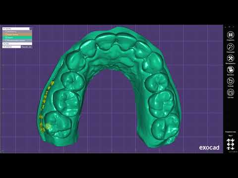 Видео: wax up цифровое моделирование для диагностики согласования плана лечения пациента. Моделировка зубов