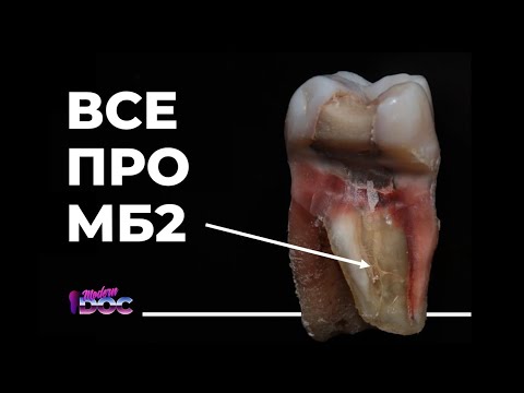 Видео: ЭНДОДОНТИЯ МБ2 КАНАЛ как найти как обработать