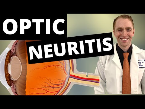 Видео: Симптомы, диагностика и лечение неврита зрительного нерва