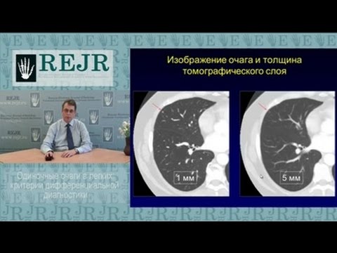 Видео: Одиночные очаги  в легких   критерии дифференциальной диагностики (Тюрин)