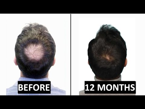 Видео: ЛУЧШИЙ ПРОТОКОЛ ПРИ ВЫПАДЕНИИ ВОЛОС НА КОРОНЕ