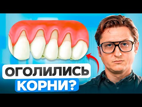 Видео: ОПУСТИЛАСЬ ДЕСНА? Вот что нужно сделать! Обязательно смотри, если у тебя проблемы с дёснами!