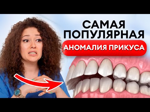 Видео: Самый ОПАСНЫЙ прикус у людей! / Как определить ДИСТАЛЬНЫЙ прикус и ВЫЛЕЧИТЬ его?