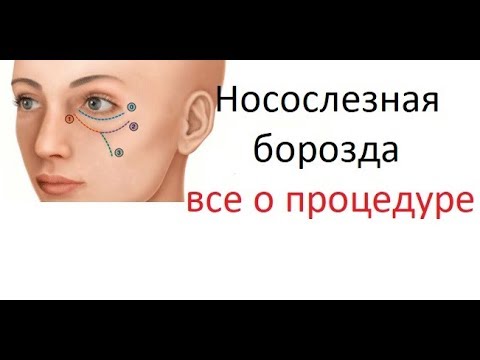 Видео: Как убрать мешки и синяки под глазами за один день. Коррекция носослезной борозды.
