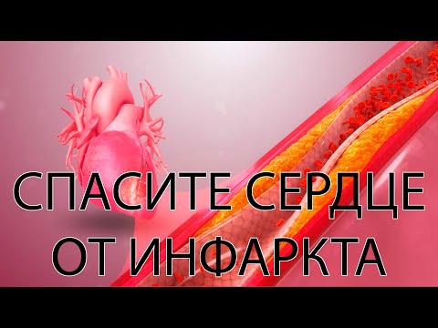 Видео: Главное упражнение при стенокардии напряжения - мини-курс
