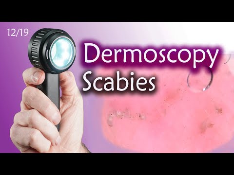 Видео: Борьба с чесоткой: основные советы по диагностике и лечению. Избавьтесь от зуда!