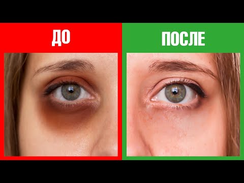 Видео: Как избавиться от темных кругов под глазами раз и навсегда?😉