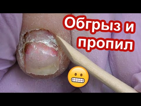 Видео: Пропилили Ногти В Школе 😬 Преображение Обгрызенных Ногтей На Формах