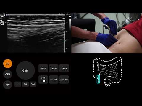 Видео: Учебное пособие по УЗИ: Аппендицит | Radiology Nation