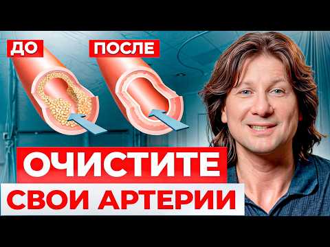 Видео: ПЕРВЫЕ симптомы атеросклероза! / Как БЫСТРО избавиться от холестериновых бляшек?