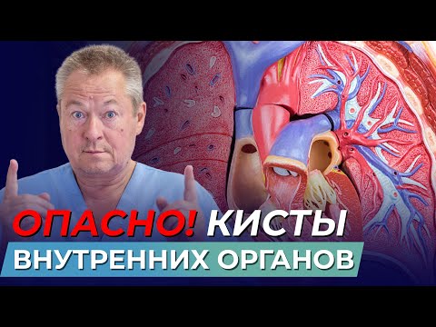 Видео: Почему появляются кисты в органах и как с ними бороться❓