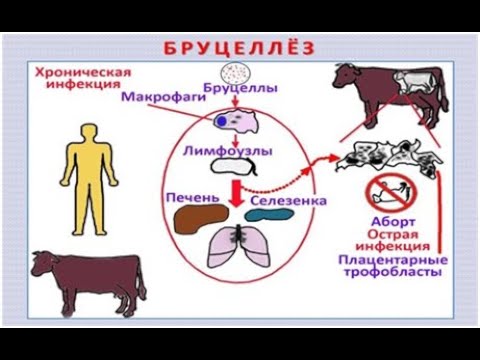 Видео: Бердибаева М.А. "Бруцеллез (Сарып)" Пәні: Жұқпалы аурулар